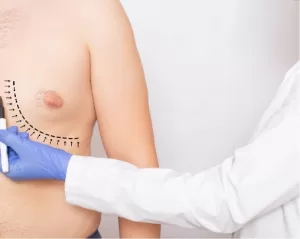 Gynecomastia Surgery