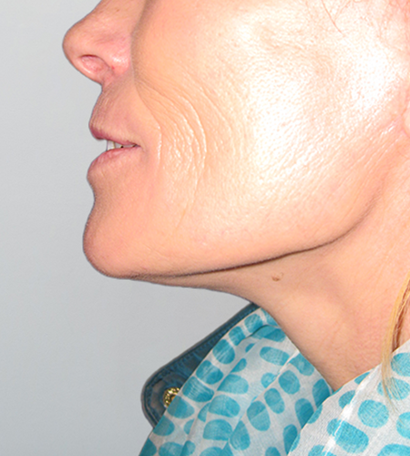 Before & After Lines And Wrinkles Treatment