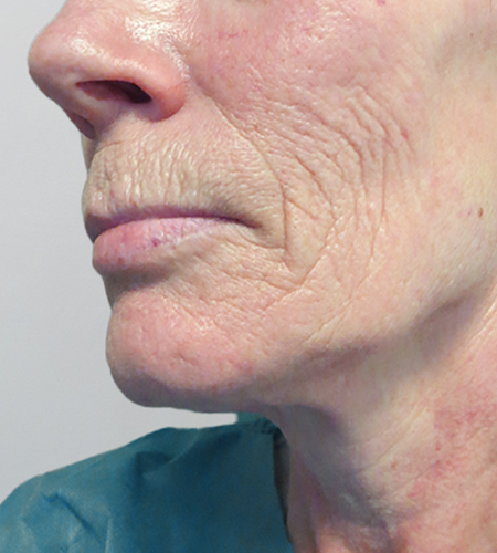 Before & After Lines And Wrinkles Treatment