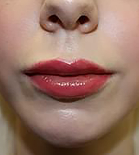 Before & After Lip Enhancement Treatment