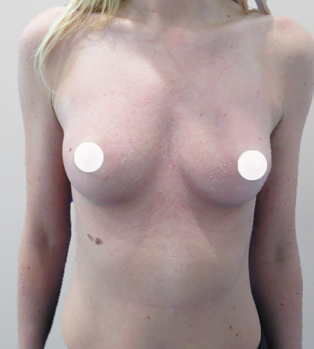 Before & After Breast Augmentation Surgery