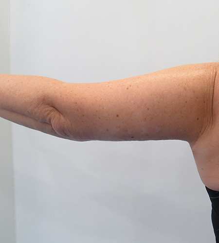 Before & After Upper Arm Lift Surgery