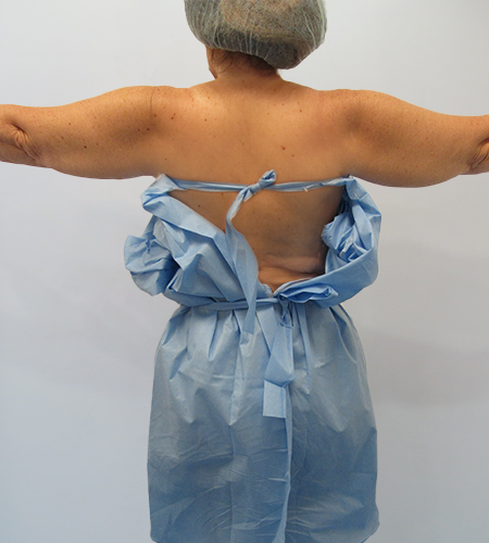 Before & After Upper Arm Lift Surgery