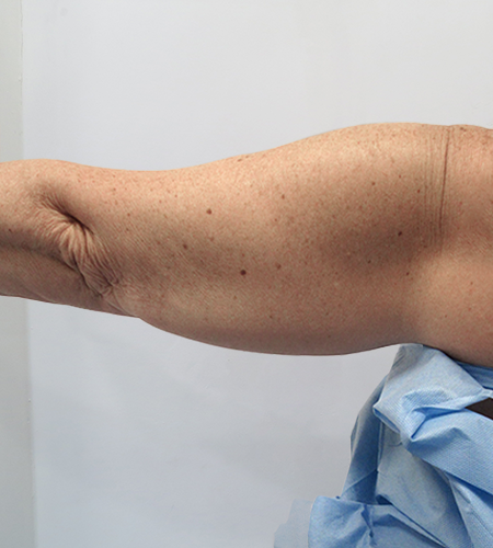 Before & After Upper Arm Lift Surgery