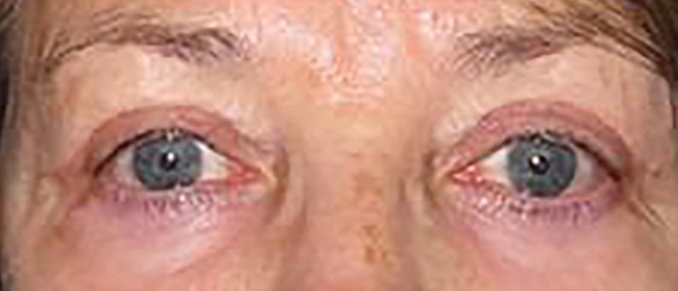 Before & After Eyelid Surgery