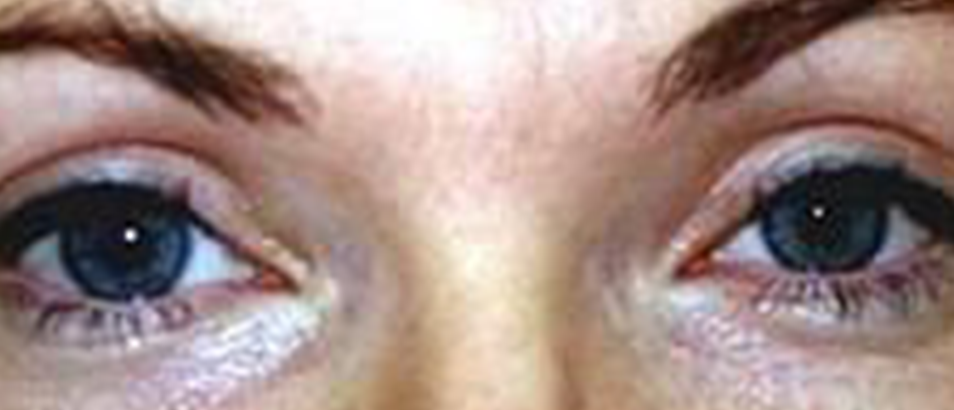 Before & After Eyelid Surgery