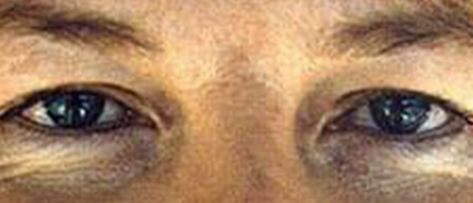 Before & After Eyelid Surgery