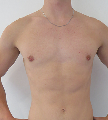 Before & After Breast Reduction Surgery