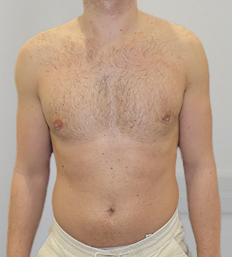 Before & After Breast Reduction Surgery