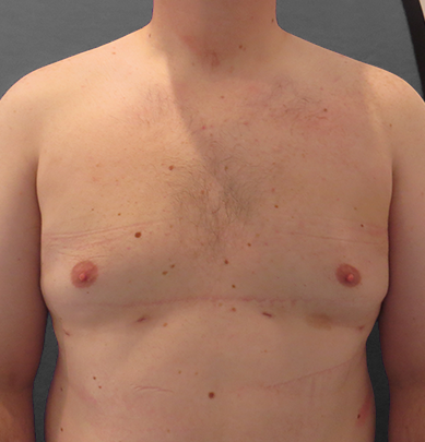 Before & After Breast Reduction Surgery