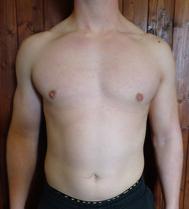 Before & After Breast Reduction Surgery