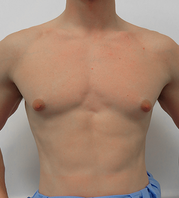 Before & After Breast Reduction Surgery