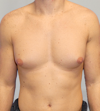 Before & After Breast Reduction Surgery