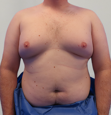 Before & After Breast Reduction Surgery