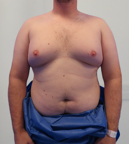 Before & After Breast Reduction Surgery