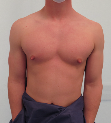 Before & After Breast Reduction Surgery