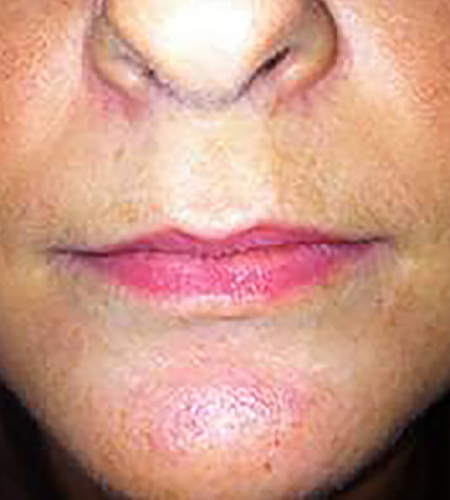 Before & After Lip Enhancement Treatment