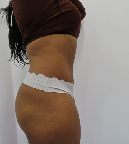 Before & After Tummy Tuck Surgery