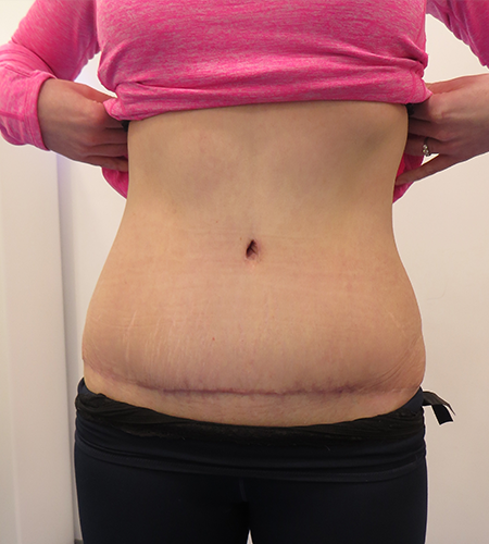 Before & After Tummy Tuck Surgery