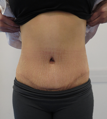 Before & After Tummy Tuck Surgery