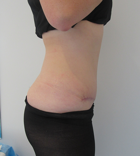 Before & After Tummy Tuck Surgery