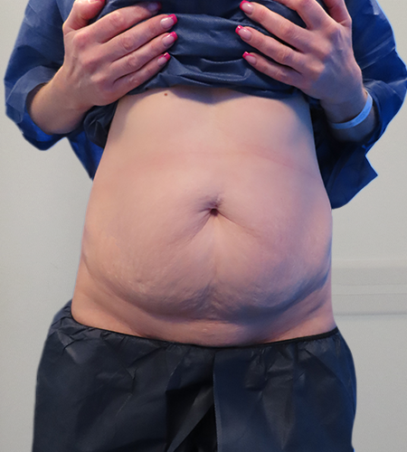 Before & After Tummy Tuck Surgery