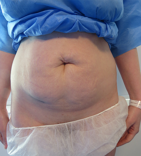 Before & After Tummy Tuck Surgery