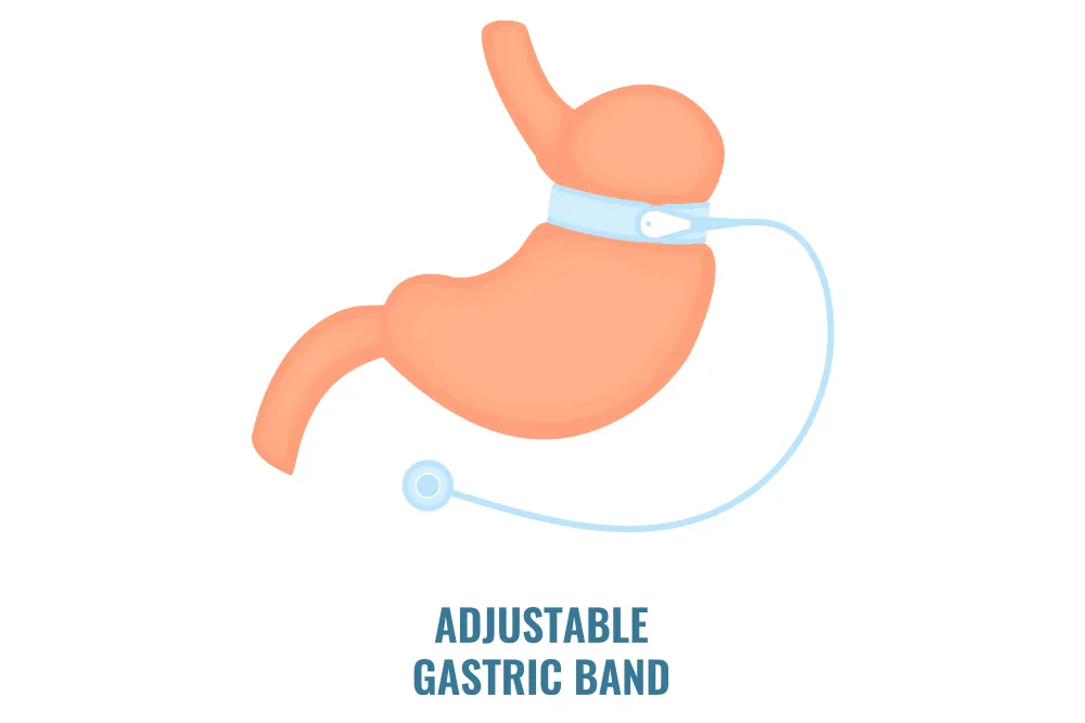 Band-gastric.webp
