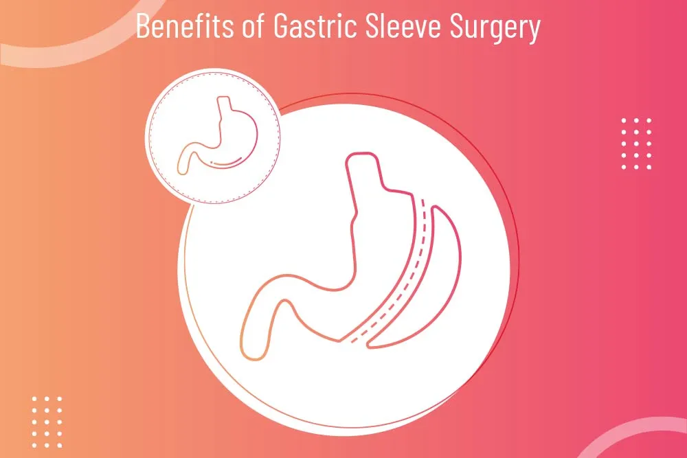 1 / 1 – Benefits-of-Gastric-Sleeve-Surgery.webp
