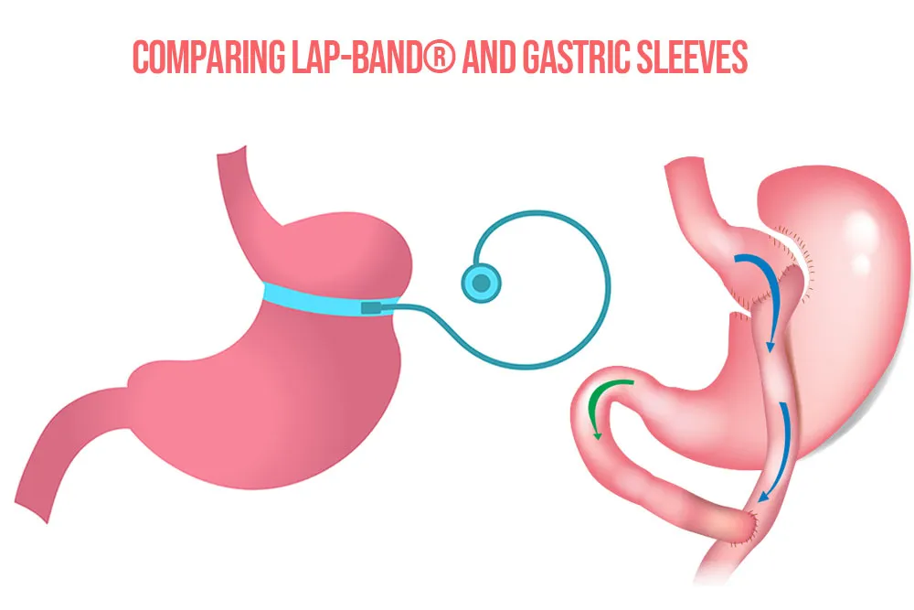 Comparing-Lap-Band®-and-Gastric-Sleeves.webp
