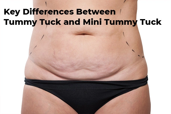 Key Differences Between Tummy Tuck and Mini Tummy Tuck