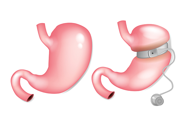 Lap-Band® Post Surgery Guide