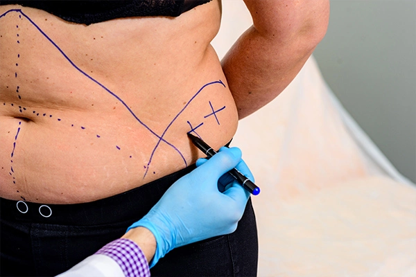 Reasons for a Tummy Tuck After Weight Loss Surgery