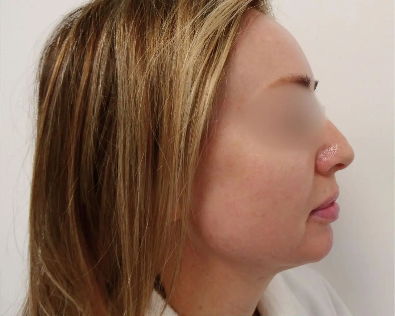 Rhinoplasty after 1