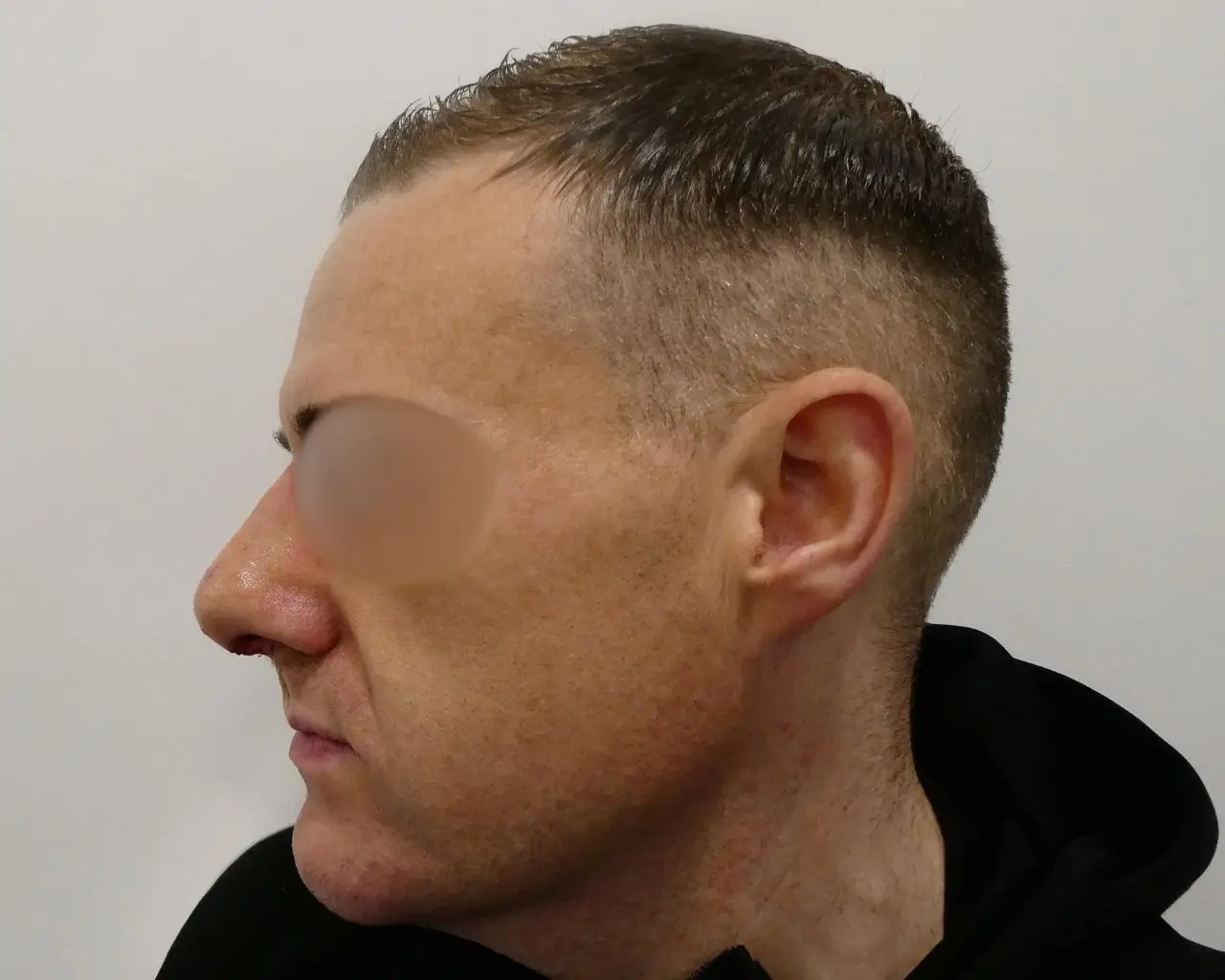 Rhinoplasty after 3