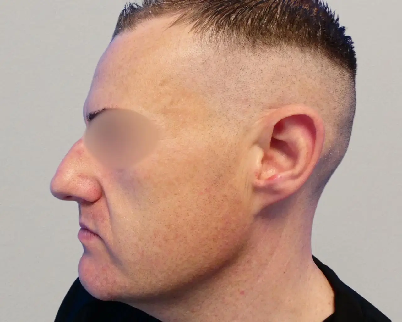 Rhinoplasty before 3