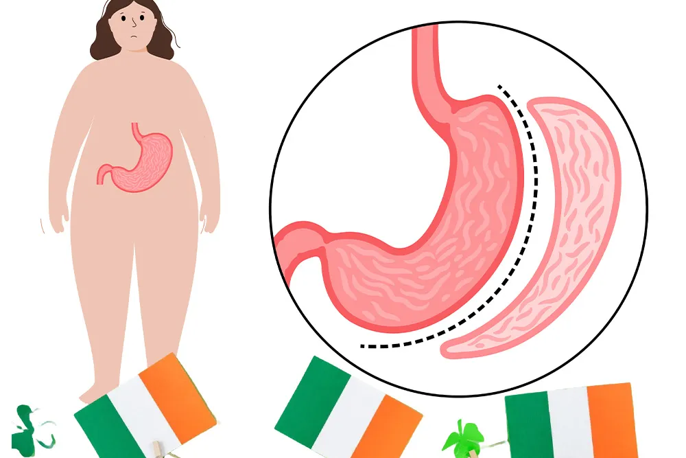 The-Complete-Guide-To-Gastric-Sleeve-Surgery-In-Ireland.webp