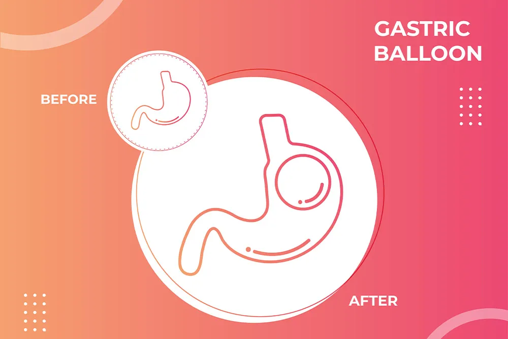 The-Complete-Guide-To-Getting-A-Gastric-Balloon-In-Ireland.webp