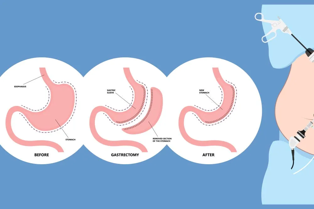 The-Gastric-Sleeve-Procedure.webp
