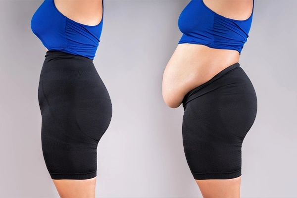 Tummy Tuck Risks and Complications for Post-Bariatric Patients