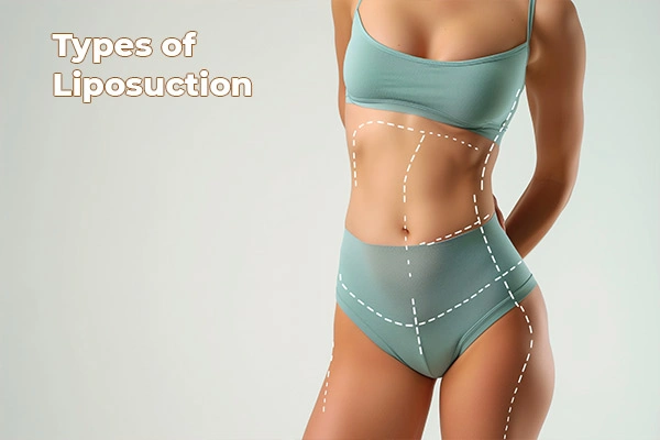 Types of Liposuction