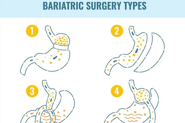 Types of Weight-Loss procedures