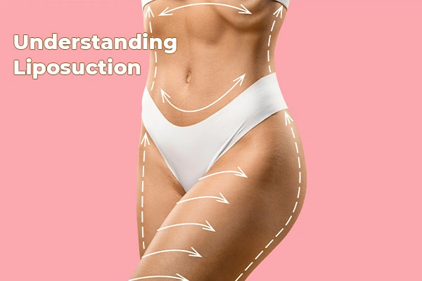 Understanding Liposuction