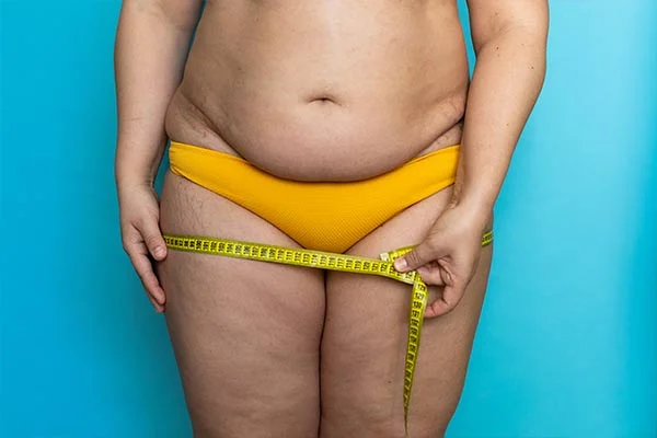 Understanding Weight-Loss Surgery 