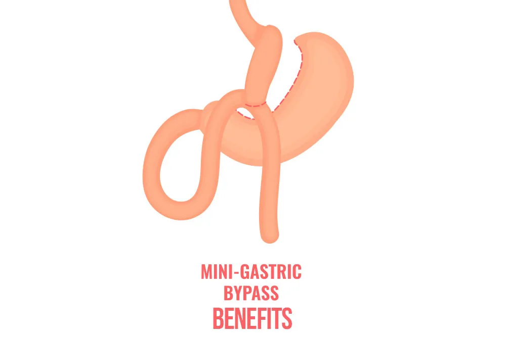 What-are-the-benefits-of-a-mini-gastric-bypass.webp
