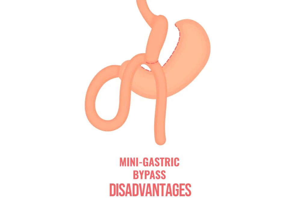 What-are-the-disadvantages-of-a-mini-gastric-bypass.webp
