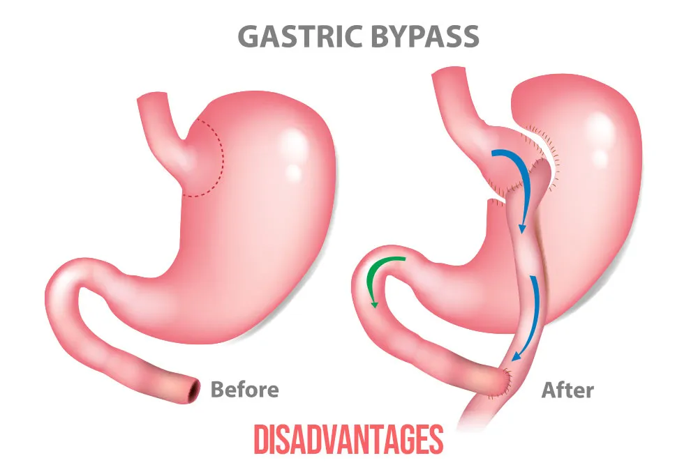 What-are-the-disadvantages-of-a-traditional-gastric-bypass.webp
