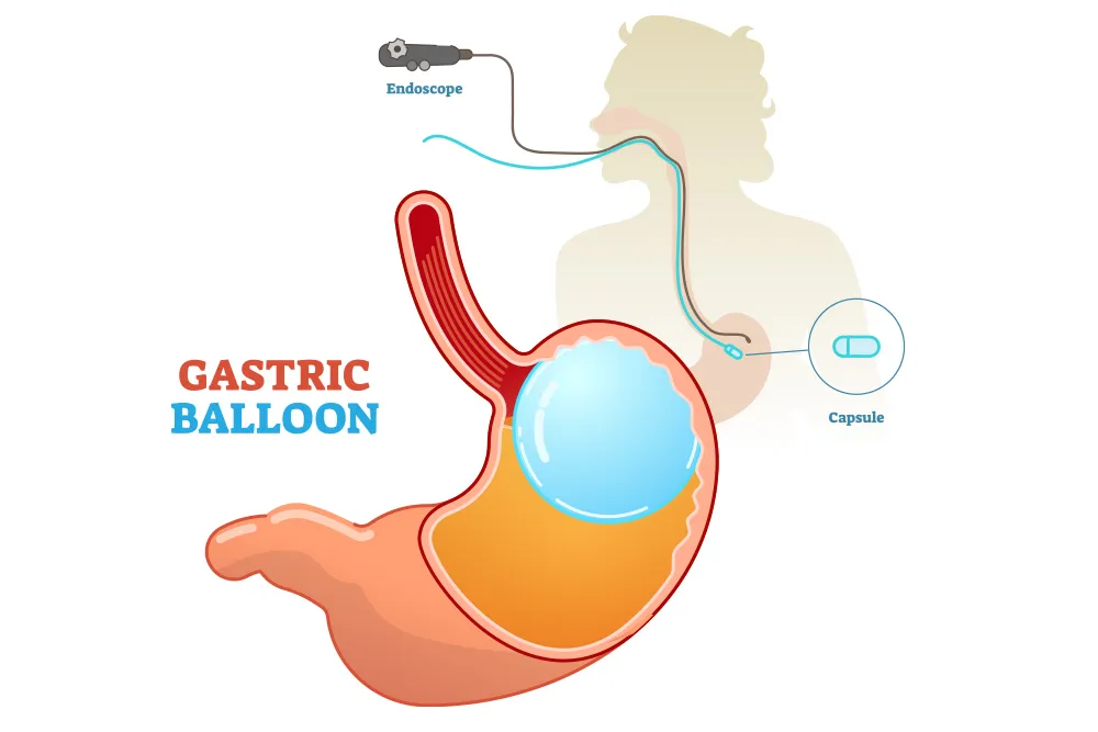 What-happens-during-a-gastric-balloon-procedure.webp
