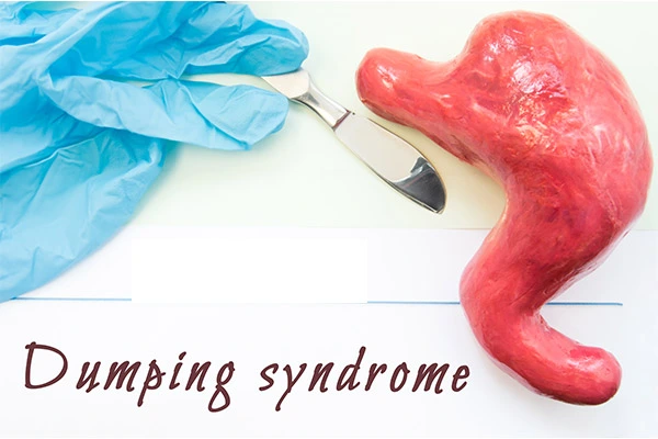  What is Dumping Syndrome