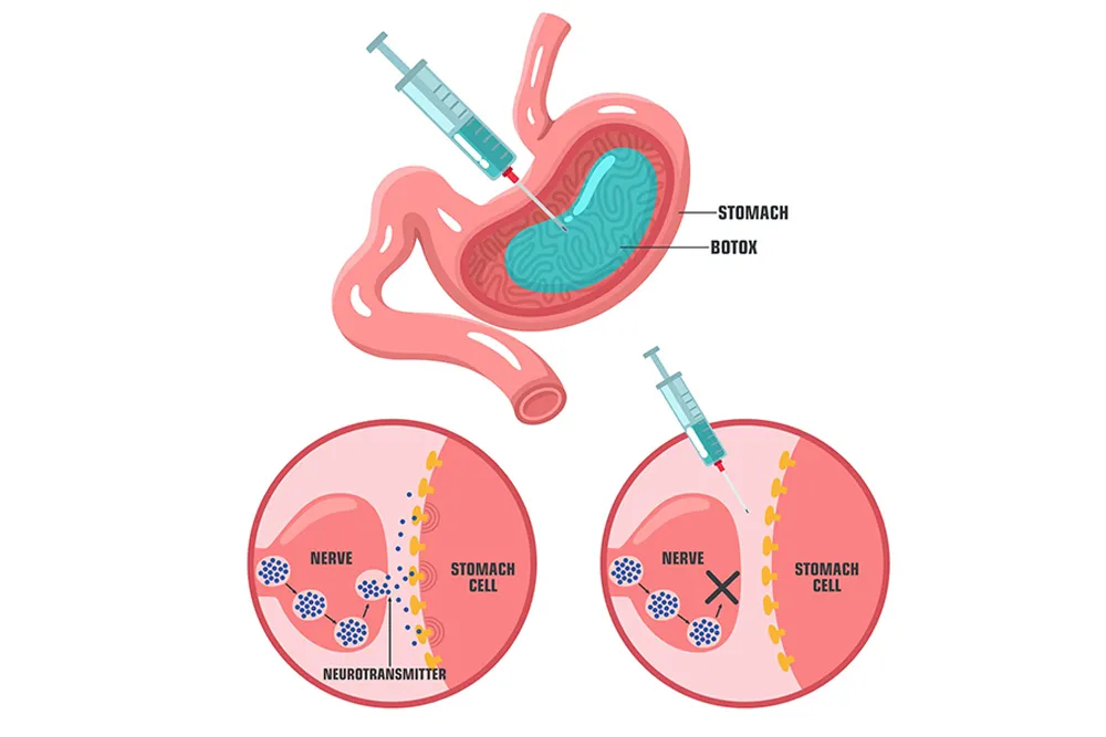 What-is-Gastric-Botox